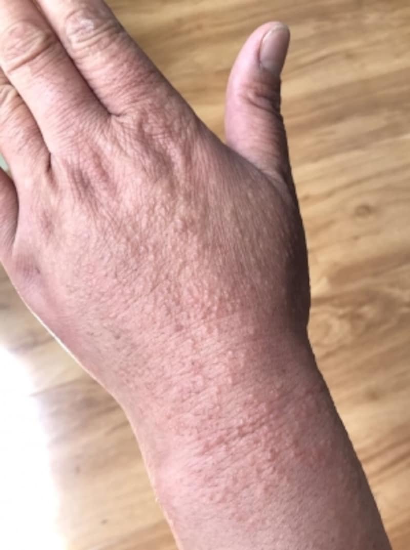 手湿疹の症状 原因 治し方 症例画像あり 皮膚 爪 髪の病気 All About 手湿疹の症状 原因 治し方 症例画像あり 皮膚 爪 髪の病気 All About