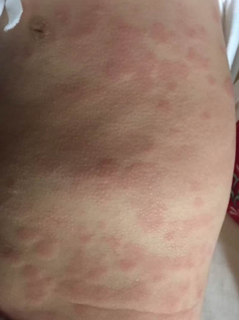 アレルギー 発疹 画像 178017アレルギー 発疹 画像