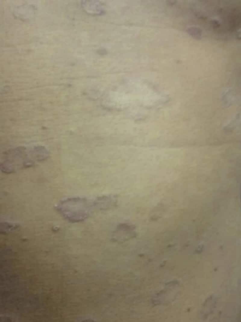 【症例写真】ジベルばら色粃糠疹の原因・症状・治療法 [皮膚・爪・髪の病気] All About