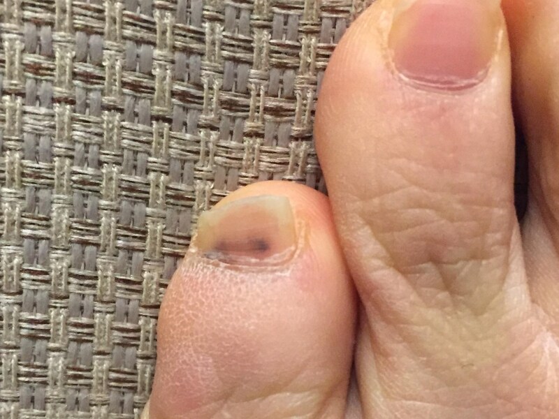 黒い足の爪の治療法は何ですか?