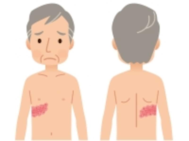 皮膚に水ぶくれや赤い発疹が帯状にあらわれます