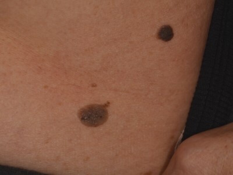 症例画像 顔のイボ 老人性イボ 脂漏性角化症 の治療 予防法 皮膚 爪 髪の病気 All About