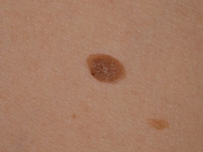 症例画像 顔のイボ 老人性イボ 脂漏性角化症 の治療 予防法 皮膚 爪 髪の病気 All About