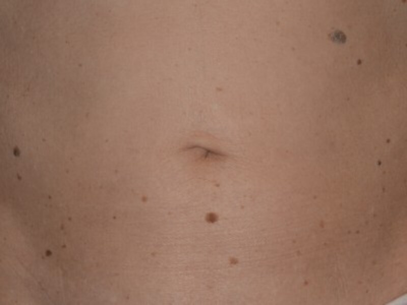 症例画像 顔のイボ 老人性イボ 脂漏性角化症 の治療 予防法 皮膚 爪 髪の病気 All About