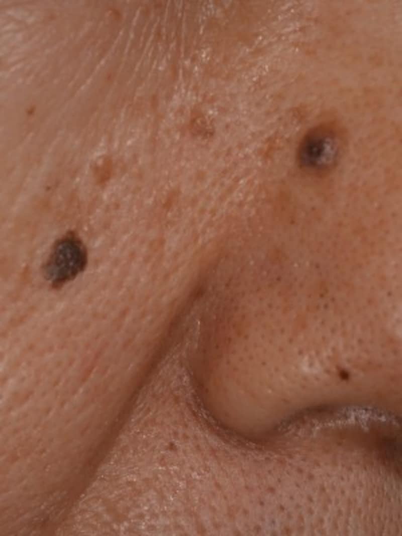 症例画像 顔のイボ 老人性イボ 脂漏性角化症 の治療 予防法 皮膚 爪 髪の病気 All About