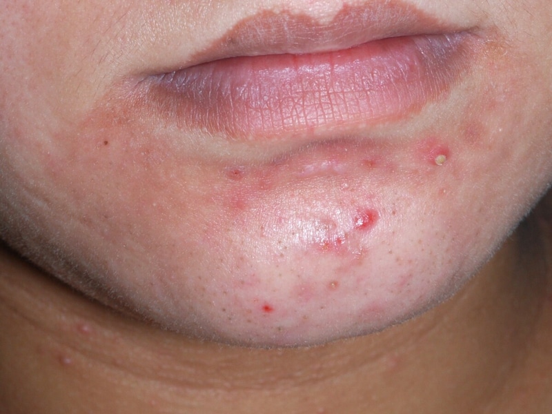 顎ニキビの写真・症例画像