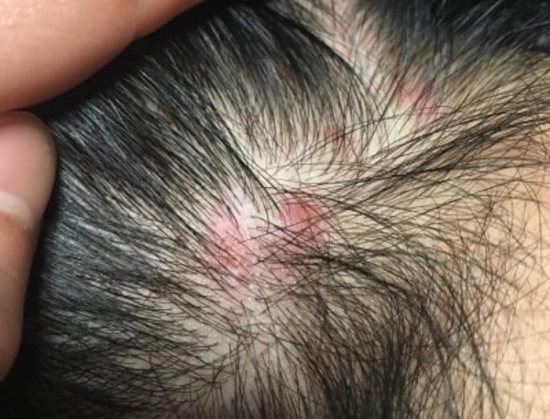 痛みやかゆみも起きやすい頭皮のニキビの原因・治し方 [皮膚・爪・髪の病気] All About
