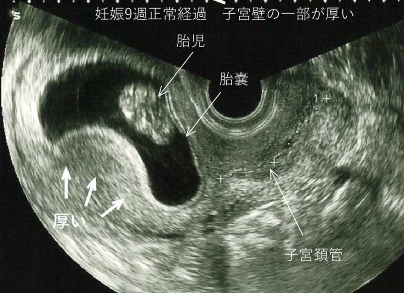 妊娠初期　腹痛