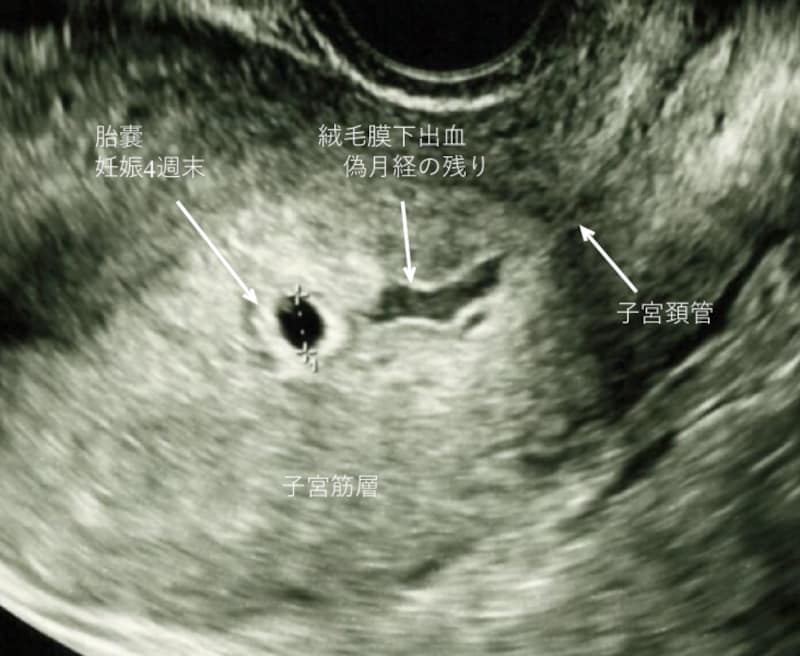 妊娠超初期の出血　予定月経期出血（偽月経）