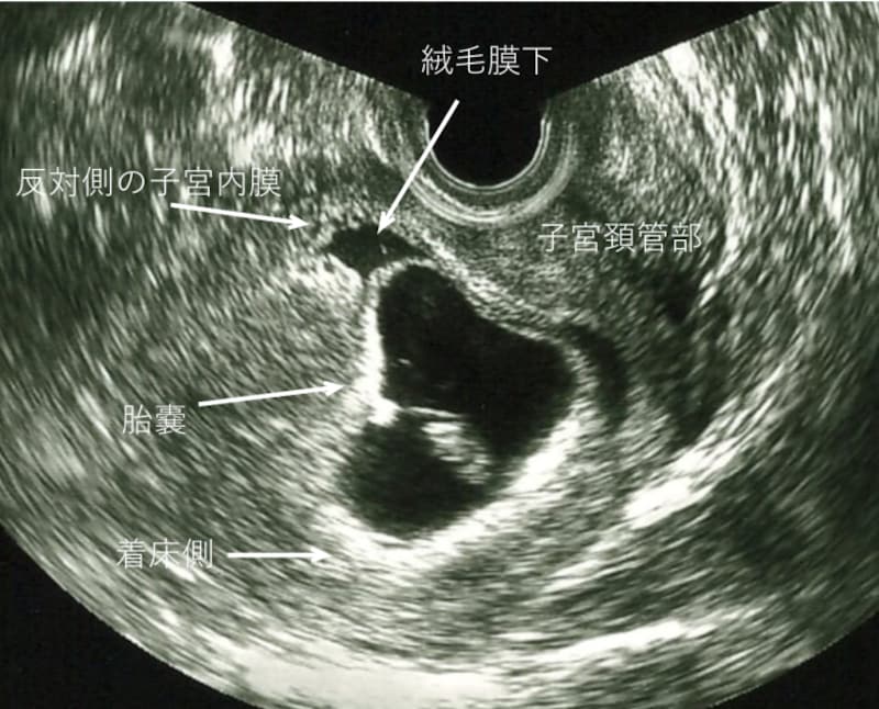 妊娠初期の出血、絨毛膜下出血