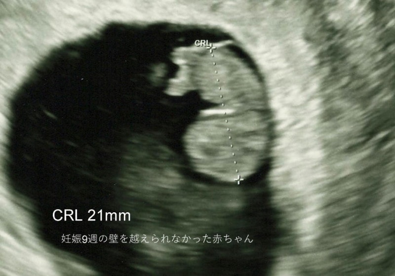 妊娠9週の壁・魔の9週・流産の壁  超音波写真
