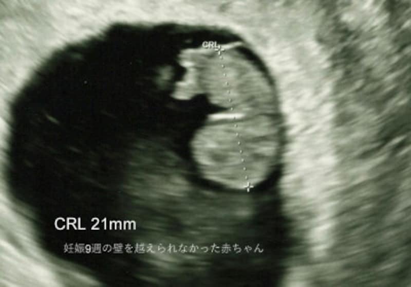 9週の壁 心拍確認後の心拍停止 魔の9週 はなぜ流産の壁なのか 妊娠初期 All About
