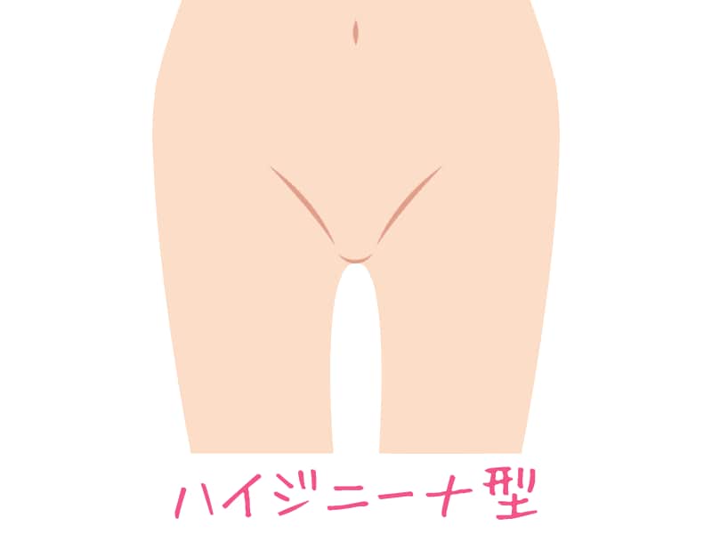 VIOすべてのアンダーヘアを処理するので、衛生的ですが自己処理ではキープするのが難しいです