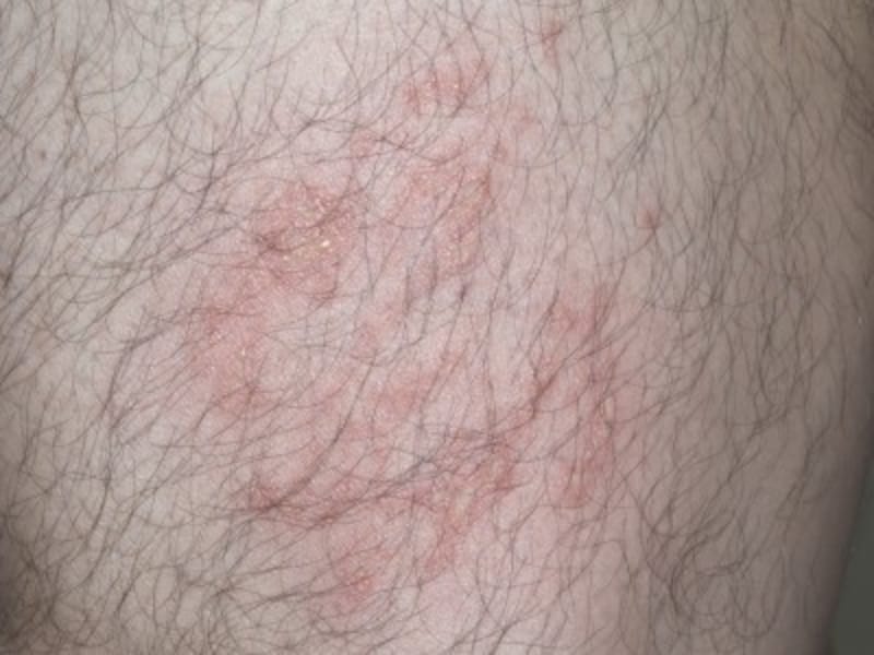 チンクイとは 海水浴性皮膚炎の対処法 予防法 治し方 皮膚 爪 髪の病気 All About