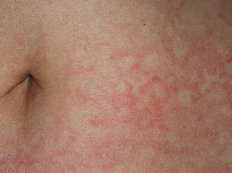 梅毒の初期症状・治療法…湿疹のような皮膚症状で気づくことも [皮膚・爪・髪の病気] All About