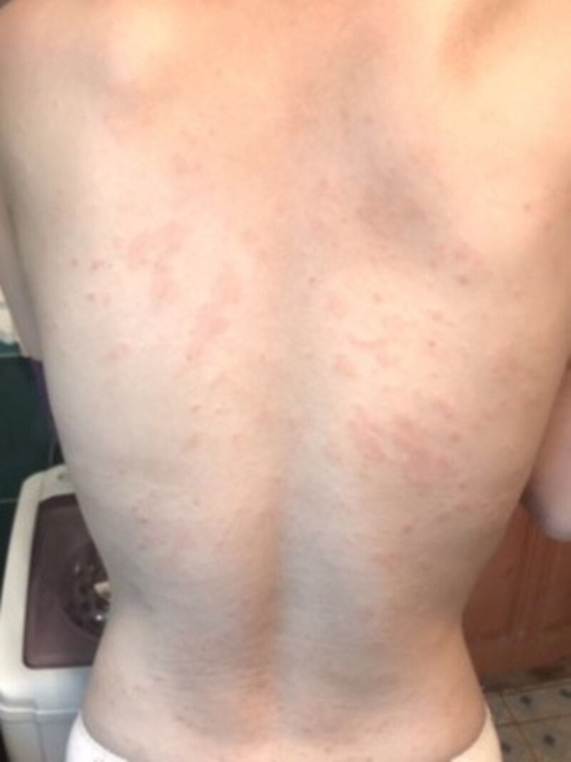 梅毒の初期症状・治療法…湿疹のような皮膚症状で気づくこと ...