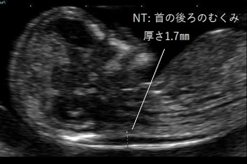 NT　胎児の首のむくみ　正常
