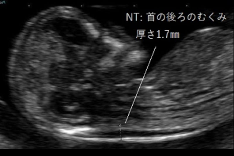 胎児の首の後ろのむくみ 浮腫 Nt とは 妊娠初期 All About