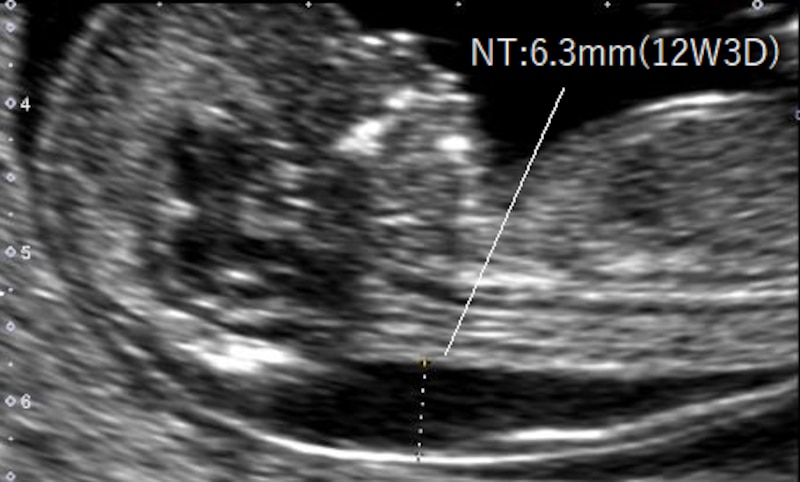 NT6mm　胎児の首のむくみ