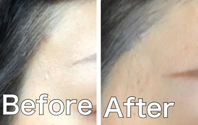 ニキビ,ニキビカバー,コンシーラー,DHC,薬用アクネケアコンシーラー