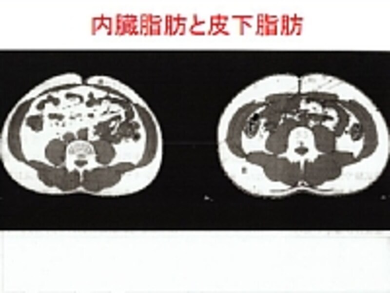 内臓脂肪型肥満