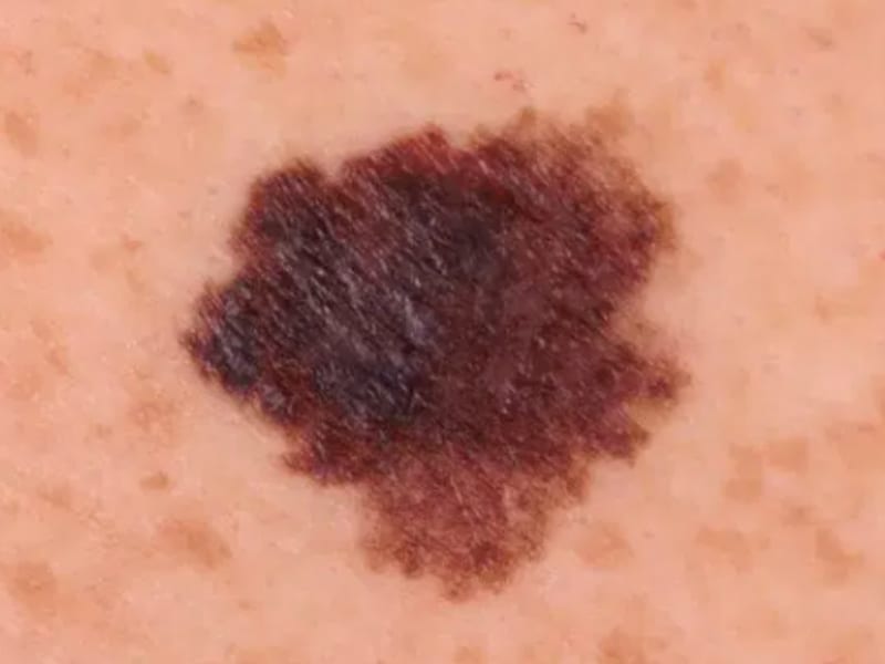 表在拡大型悪性黒色腫