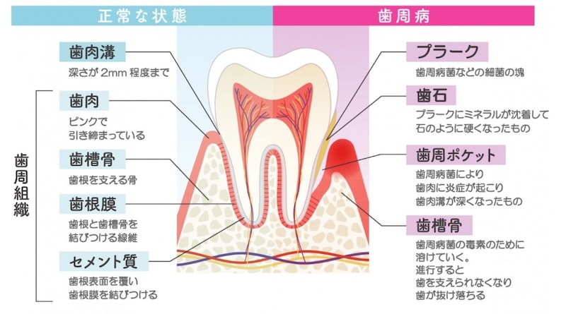 歯周病