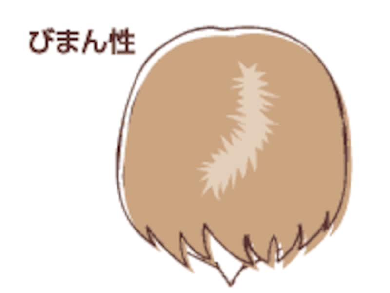 男女の薄毛の違い
