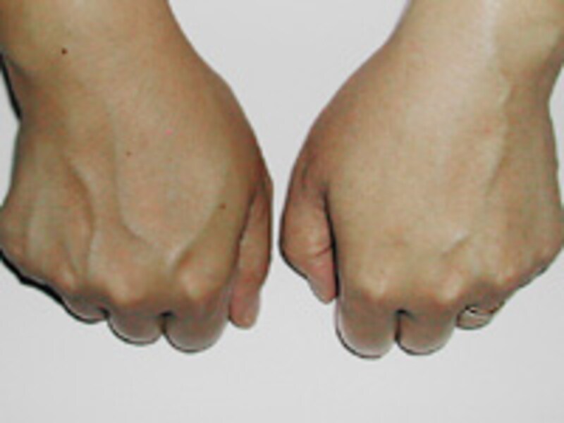 パッティング後の手