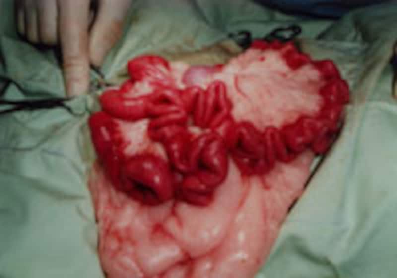 腸がアコーディオン状に!