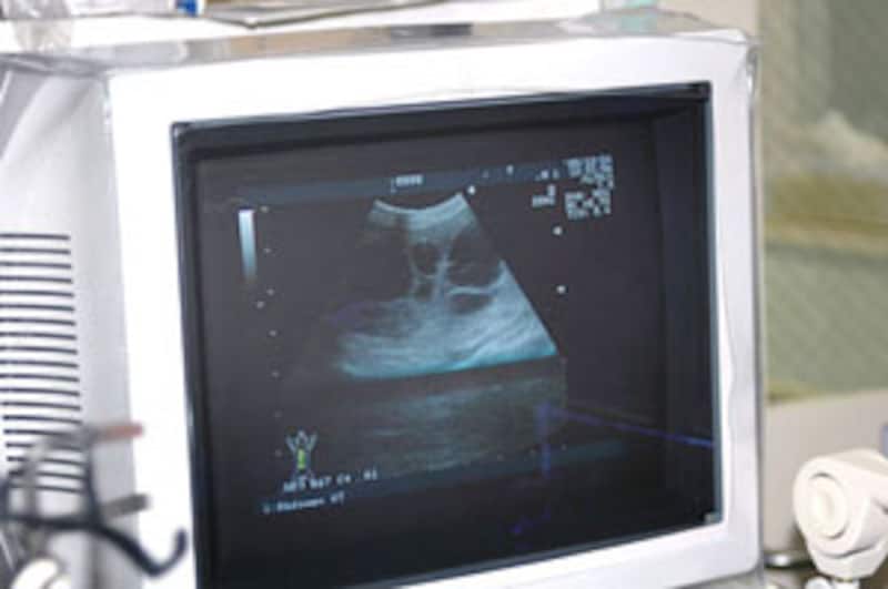 内臓のエコー検査