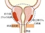 前立腺がんの治療