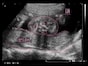 妊娠22週 エコー写真で見る胎児の大きさ・胎動・「22週の壁」とは