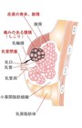 乳腺炎の治し方には、マッサージや食事による方法と、上の画像のように本格的な症状が出た場合は、医師による治療が必要な場合があります。