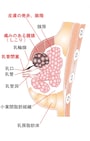 本格的な乳腺炎