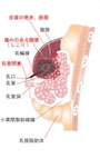 重症乳腺炎