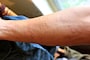 海,刺された,海で何かに刺された,刺される,チンクイ,刺されやすい人,海で刺される,ミミズ腫れ,海で刺された,チクチク,腫れ,何かに刺された,水ぶくれ,腫れる,海で刺された