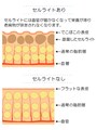 セルライトの仕組みを詳しくチェック！