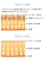 セルライトの仕組みを詳しくチェック！
