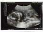 妊娠20週（妊娠6ヶ月,六ヶ月,6カ月）エコー写真・超音波写真