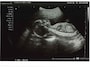 妊娠21週（妊娠6ヶ月）のエコー写真・超音波写真
