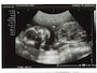 妊娠20週（20w）のエコー写真・超音波写真