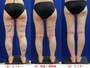 下半身脂肪吸引手術のビフォーアフター