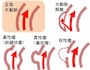 大動脈瘤のいろいろ