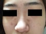 ニキビ炎症後色素沈着