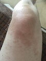 接触皮膚炎炎症後色素沈着
