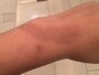熱傷炎症後色素沈着