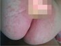 おむつかぶれの症例写真