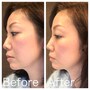 イヤーアップ,avex beauty method,耳にかける美顔器,美顔器,イヤーアップ効果