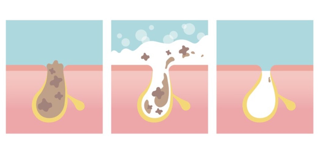 古い角質をとれば毛穴のケアにも